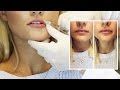 ▷ 1 syringe volbella lips in 2021 ◁✅