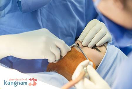 Nâng mũi có để lại hậu quả 1