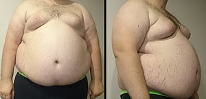 Picture of an Obese Teenager (146kg/322lb) wit...