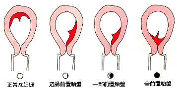 女性のカラダはデリケートなもの さまざまな変調が大きな病気へとつながることも 大切な体だけに病気を知ることは必要なことです 選択してください 妊娠中の風邪 妊娠中のタバコ 骨と女性 日ごろの注意で早産予防 出血 ドクターアドバイス 急に