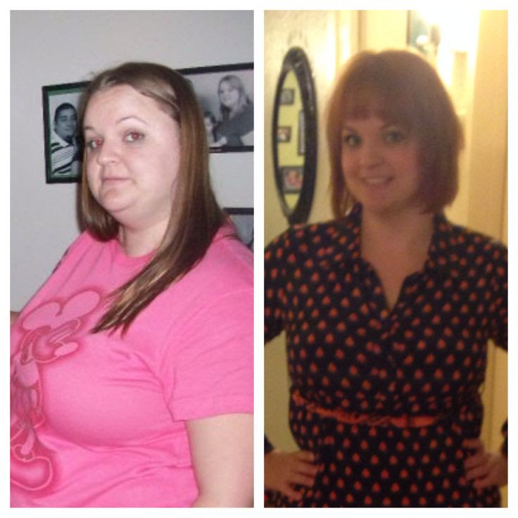 Gastric Sleeve Surgery Before And After