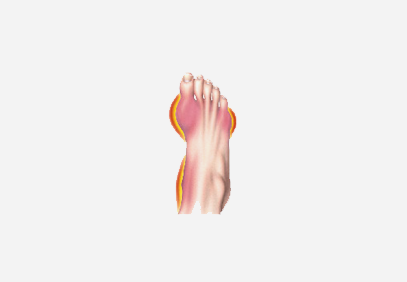gout introduction to gout gout can be a painful condition which often ...