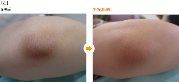 ボディqyagトーニング 乳輪 ワキ ソケイ部などの黒ずみ 名古屋タワーサイドクリニック