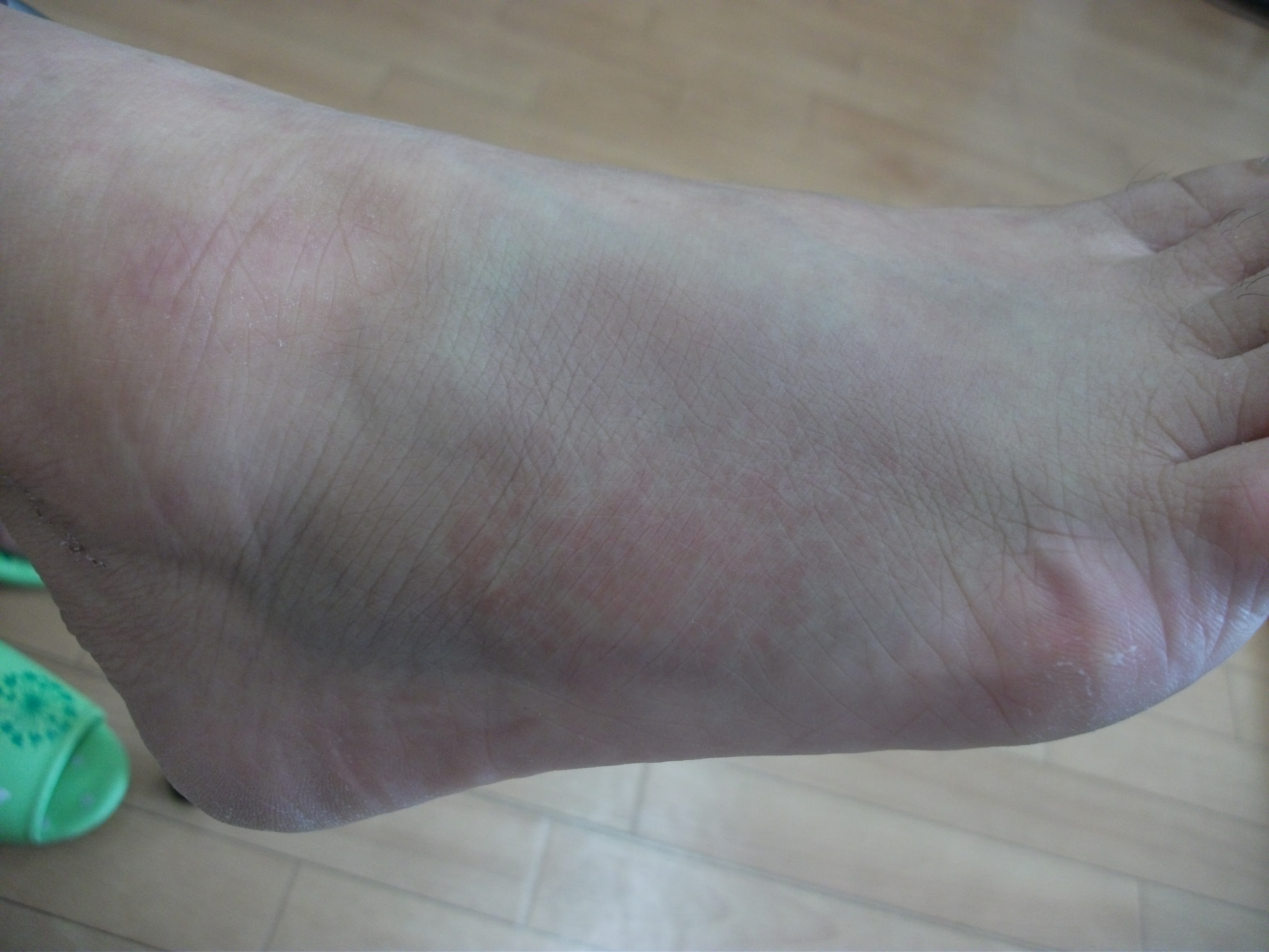 坂戸市主婦 足の痛み 下駄骨折 Blog 鶴ヶ島市 坂戸市 川越市で痛み しびれ 交通事故によるむち打ち等の治療はふじみ接骨院