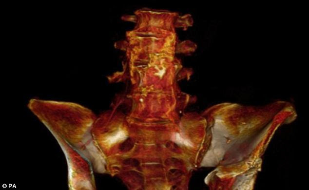 Only the ancient Egyptians were wealthy enough to have enjoyed the fat-laden diet and sedentary lifestyle commonly associated with the disease. Yet atherosclerosis was discovered in common people from the other four cultures. A previous study shows a mummy from 200-900 AD of a Peruvian woman in her 40s, excavated from Lima, with calcifications in the arteries