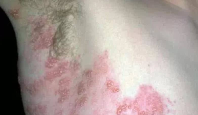 How to Get Rid of an Armpit Rash