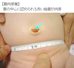 臍腸管遺残 尿膜管遺残 日本小児外科学会