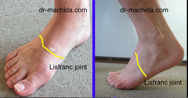 変形性リスフラン関節症に関する質問集