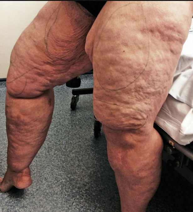 Wife loses 36 inch thighs after 12 litres of fat is sucked from her legs