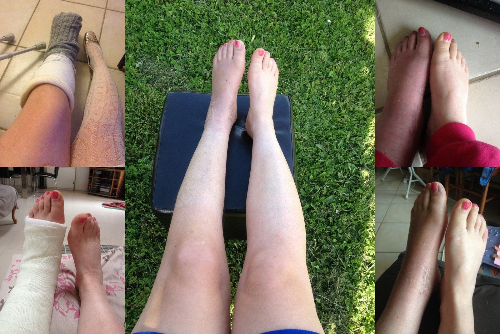 Déjà 5 Mois Que Jai La Jambe Cassée Charlotteblabla