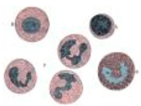 Lymphopenie et monocytose