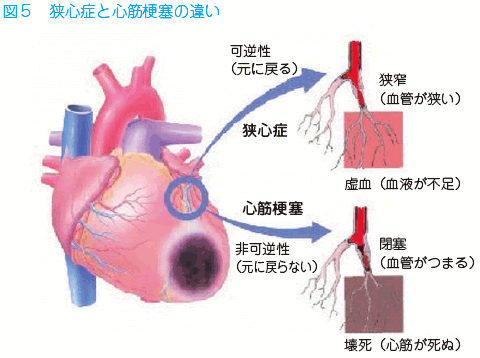 92 心筋梗塞が起こったら 心臓 循環器病あれこれ 国立循環器病研究センター 循環器病情報サービス