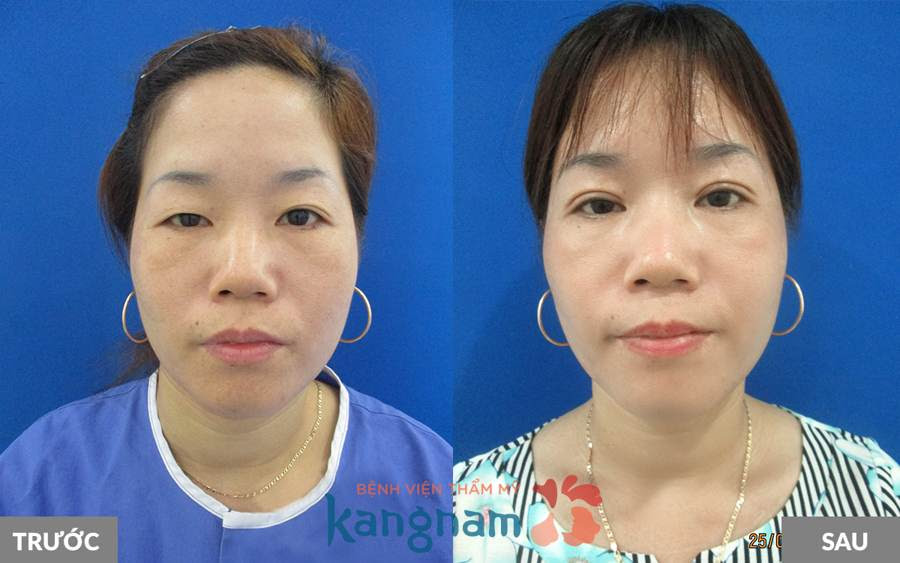 Chỉnh sửa mắt xếch22