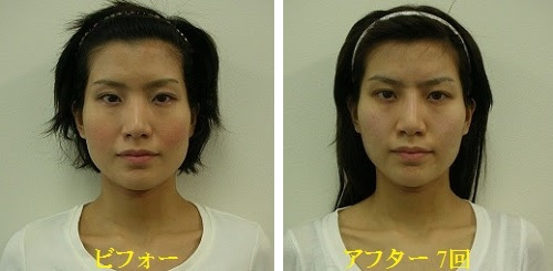 小顔矯正 顔の歪み矯正 ビフォーアフター画像 動画 体験談 関西プロポーション小顔センター大阪梅田院