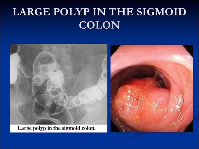 Prostate Cancer Vs Colon Cancer - Incidental Bladder Cancer in a Patient with End Stage Renal Disease