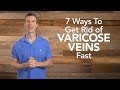 3-Day Method To Stop & Prevent Varicosis