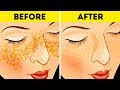 How to Get Rid of Acne Scars In Just 3 Days