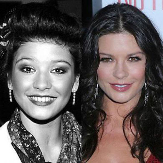 Famosos antes e depois da cirurgia plástica