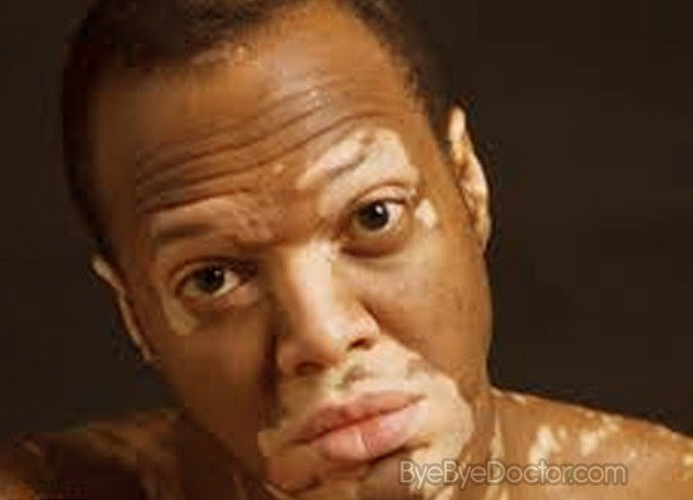 vitiligo 5 Vitiligo