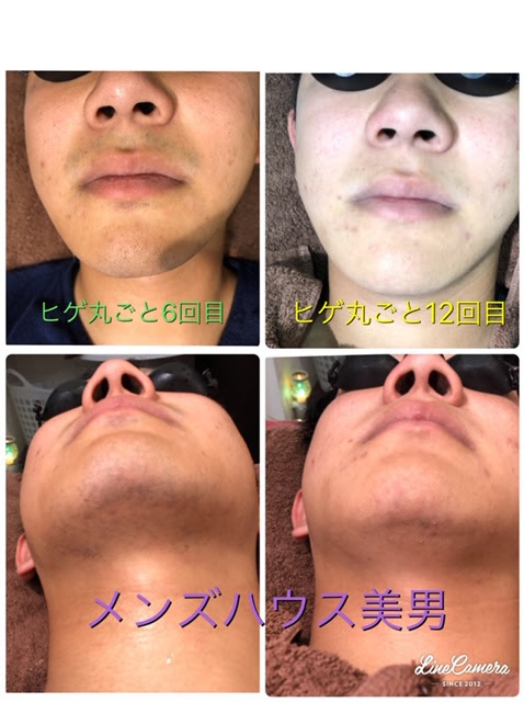 美男の脱毛マシンは 男性の頑固で太い毛にも 効率よく処理ができる メンズ脱毛 フェイシャル 美男 群馬県太田市