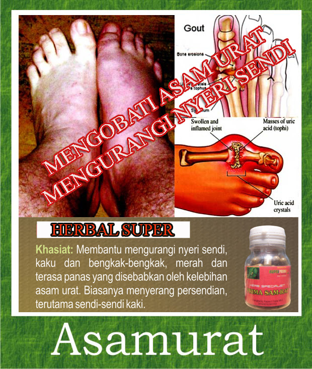 7 Obat Asam Urat Di Apotik Untuk Meringankan Gejala