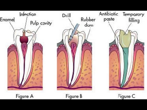 Painless Root Canal Alternatives - m