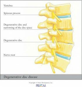 1 benh dau that lung1 281x300 Yếu cơ – Nguyên nhân phổ biến gây ra đau lưng
