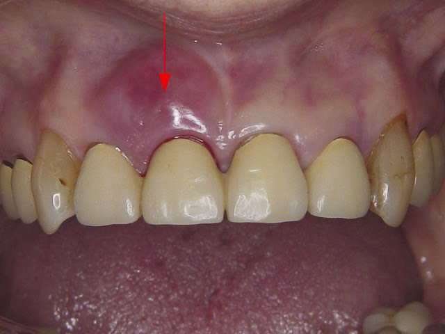 むし歯 歯周病 歯周病 舩坂歯科医院 静岡県浜松市中区 自由診療専門歯科医院