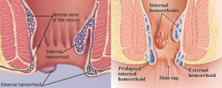 What You Should Know If You Are Struggling With Hemorrhoids