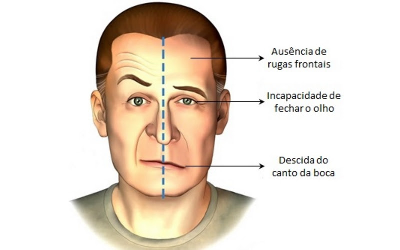 Resultado de imagem para avc