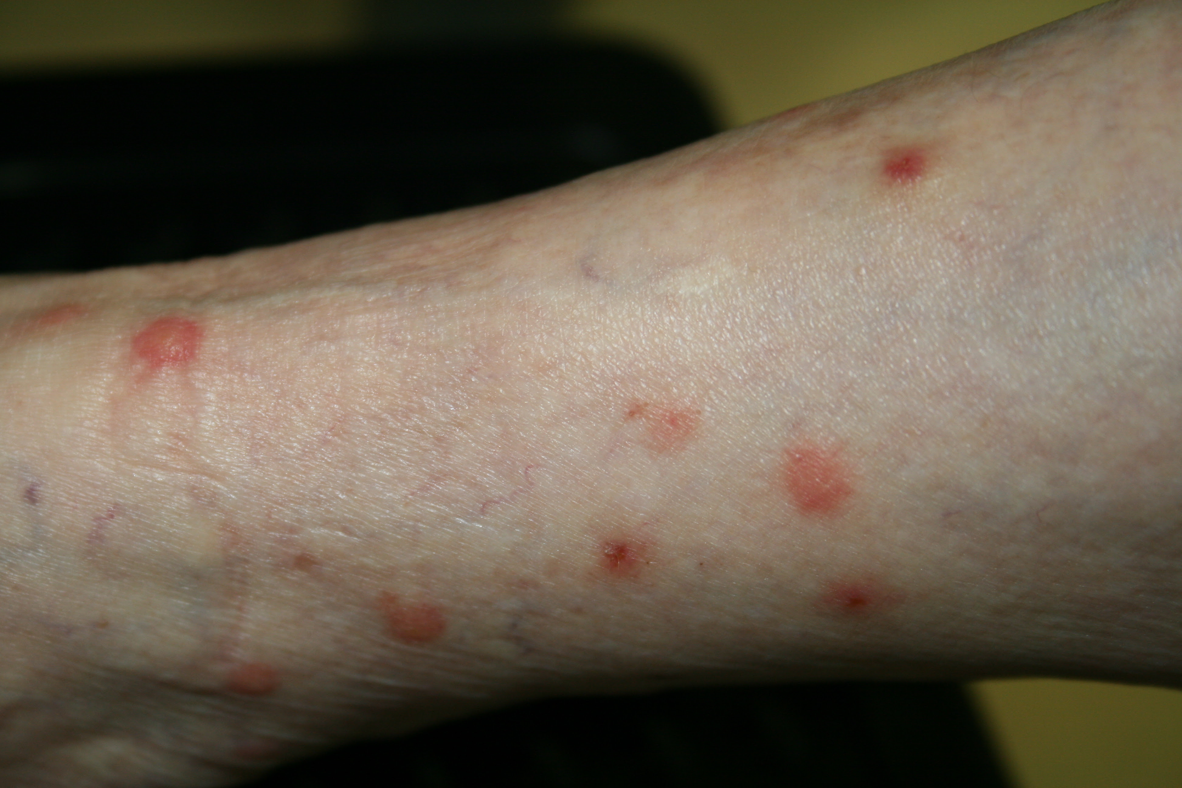 虫刺症ちゅうししょう 虫刺され