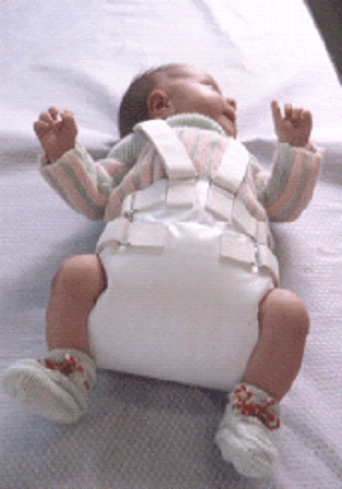 Pediaos Fr L Orthopedie Pediatrique Expliquee Aux Parents
