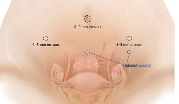 عملية ازالة الرحم