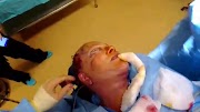 Full Face, Neck, Brow Bi Lateral Upper and Lower Eye Lid Lift: How a Full Face Lift is Done