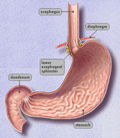 Acid Reflux Disease GERD