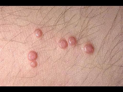 signs and symptoms and symptoms of hpv cervical most cancers