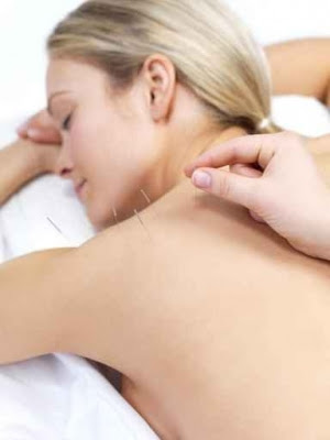 Acupuncturegirl Jpg