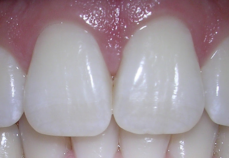 Home Remedies for Whiter Teeth - Dazzling White Teeth HQ