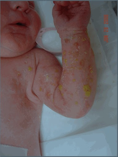 Grj 色素失調症 ブロッホ サルツバーガー症候群