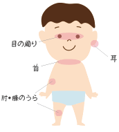 アトピー性皮膚炎とは Seastar 医療従事者向け情報