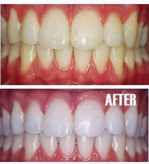 So why not whiten your teeth with products that you can buy at the 