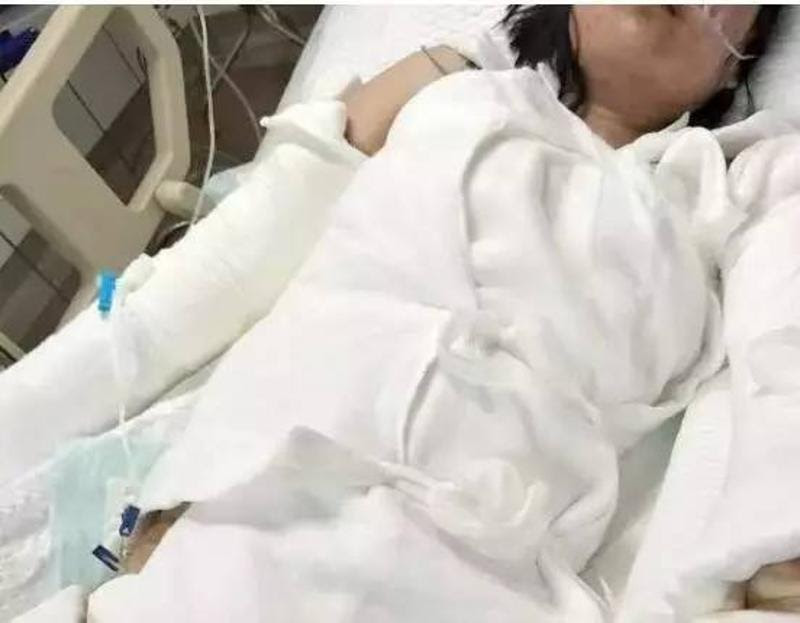 可怕 滚烫的热水 从天而降 岁女孩全身烫伤进icu