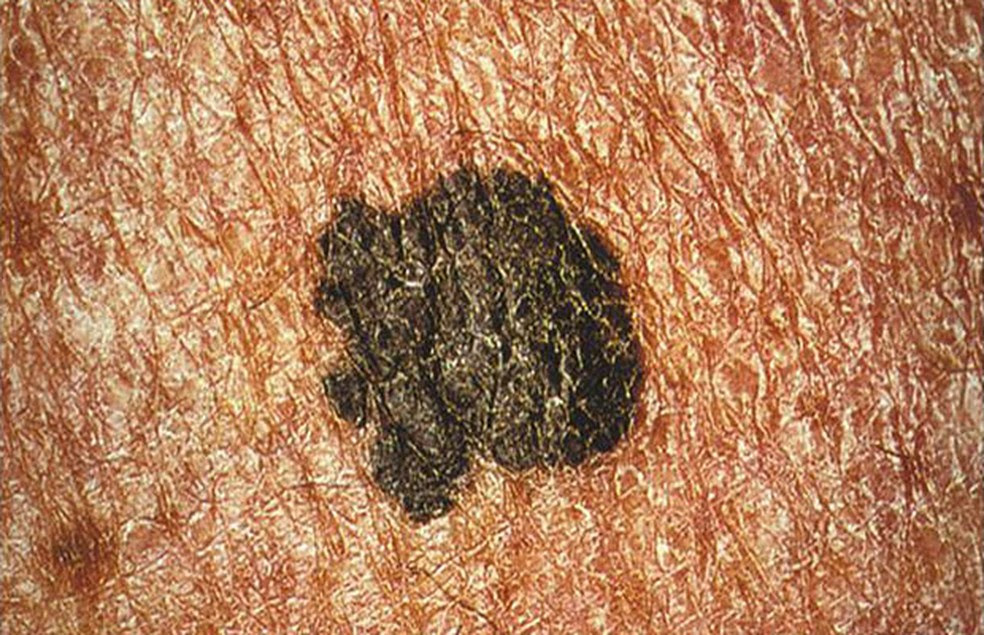 Lesão diagnosticada como melanoma; estudo descobriu proteína que tem papel importante na metástase desse tipo de câncer (Foto: CDC/ Carl Washington, M.D., Emory Univ. School of Medicine; Mona Saraiya, MD, MPH)