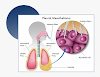 Mesothelioma Lung Cancer / Pleural Mesothelioma Stages Treatment Prognosis : We also explore how it is diagnosed and the many treatment options now available should you be unfort.