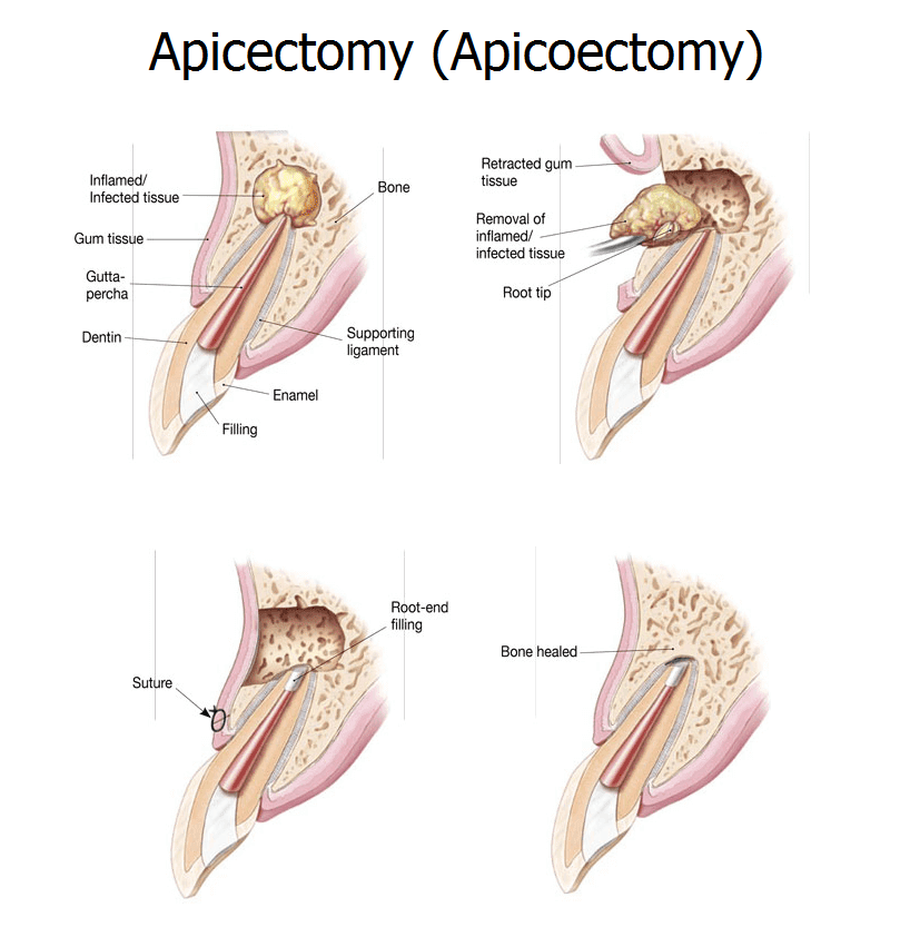 Apicoectomy tooth