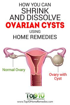 Top Home Remedies for Ovarian Cyst That Will Make You