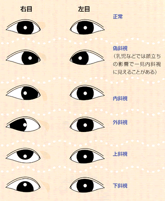 斜視 弱視 古川中央眼科