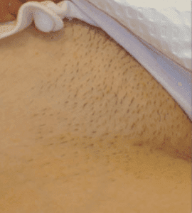 Laser Hair Removal Cost : Bikini Line Hair Removal treatment in Norwich | The Doctors Laser ClinicLaser Hair Removal Cost / Pigmentation Removal - Ada Aesthetic Medicine