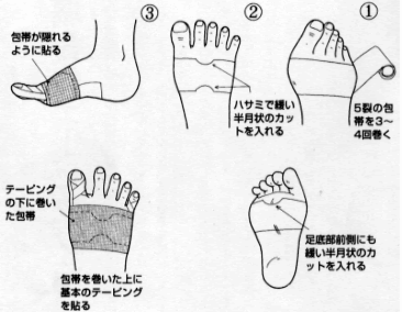 外反母趾治療の基本 足裏バランスケアテーピング