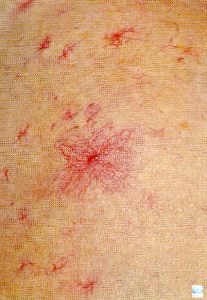 Global Dermatology » Alcohol (OH) and the Skin - Cirrhosis ...